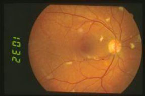 Microangiopatia-da-HIV 01