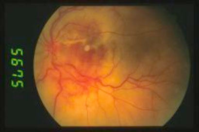 Retinite-acuta-da-Herpes