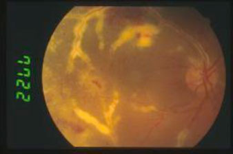 Retinite-da-CMV 03