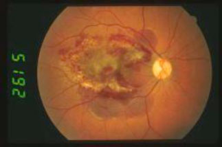 Retinite-da-CMV 05