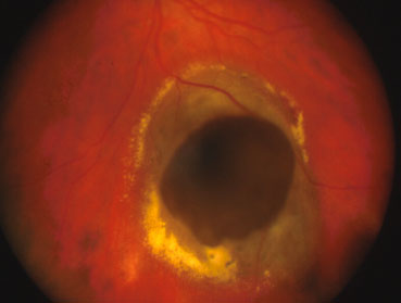 il-melanoma-uveale 01