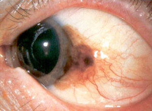 melanoma-congiuntivale 02