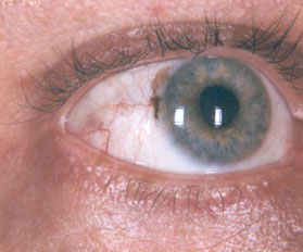 melanoma-congiuntivale 03